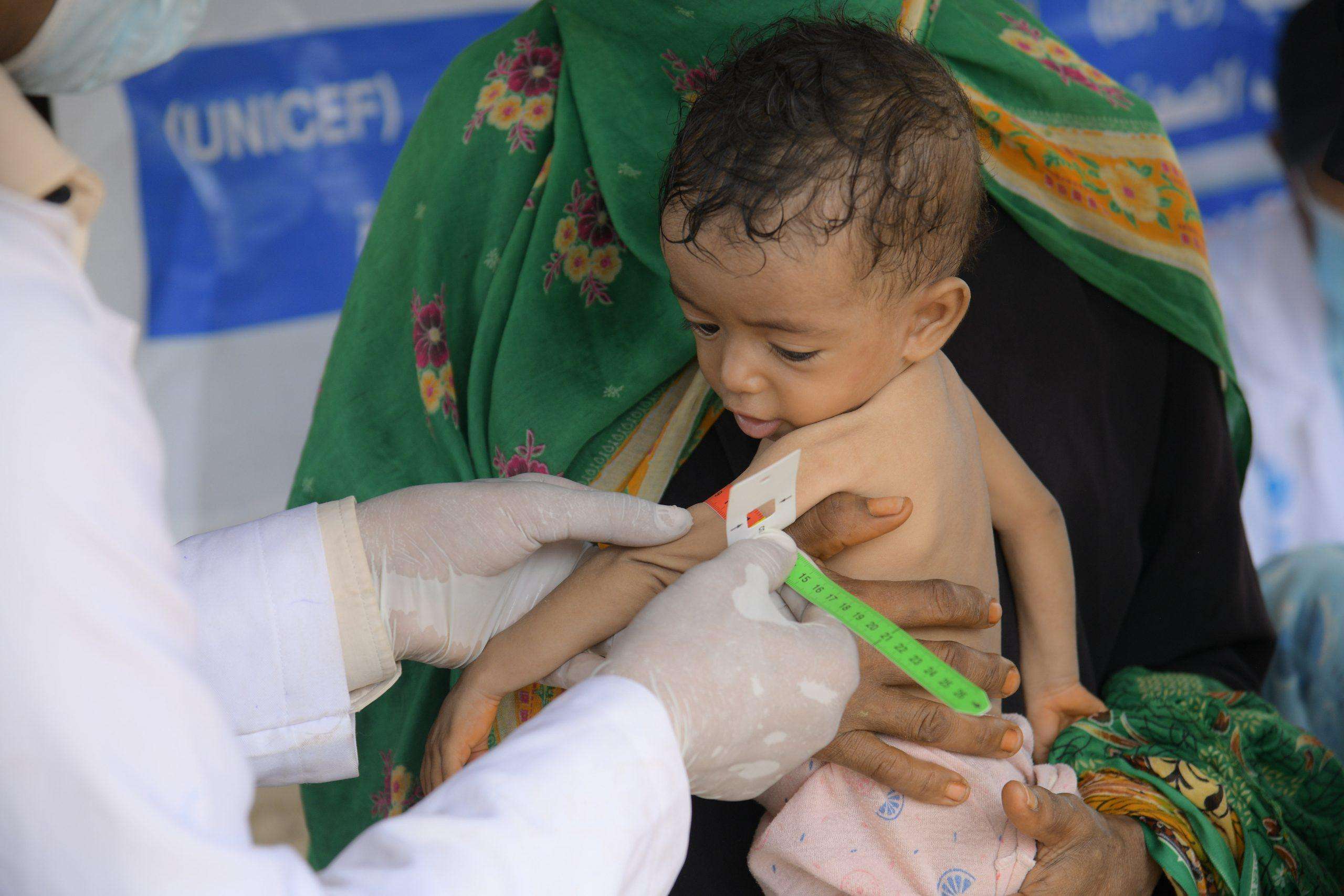 Malnutrition threatens the lives of Children U5 & PLWs in Yemen